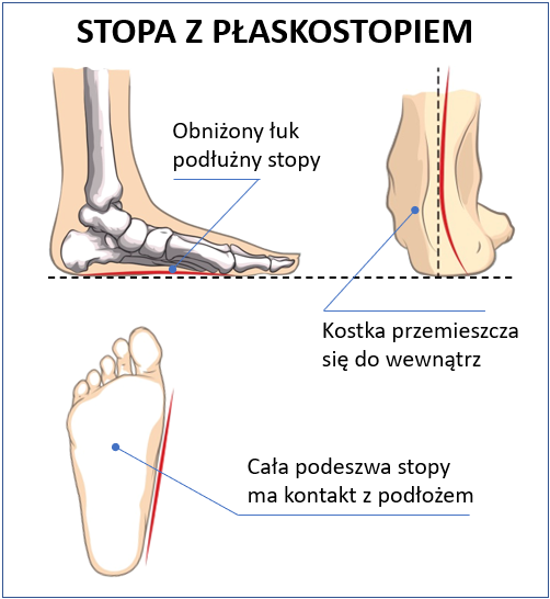 p-askostopie-poprzeczne-i-pod-u-ne-objawy-przyczyny-charakterystyka